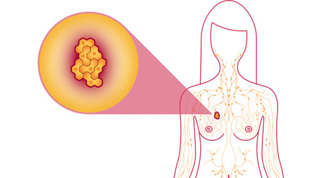 Breast and cervical cancer for Gps